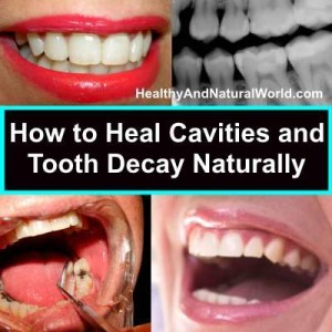 heal tooth decay naturally