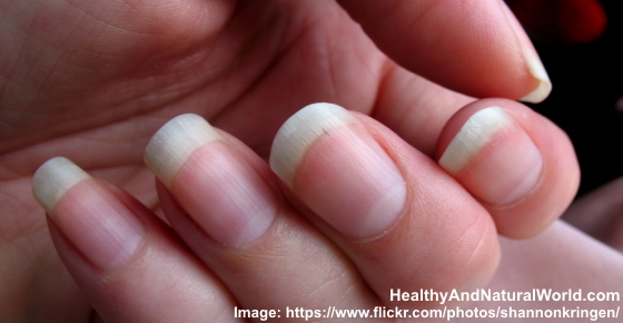 What causes fingernails to separate?