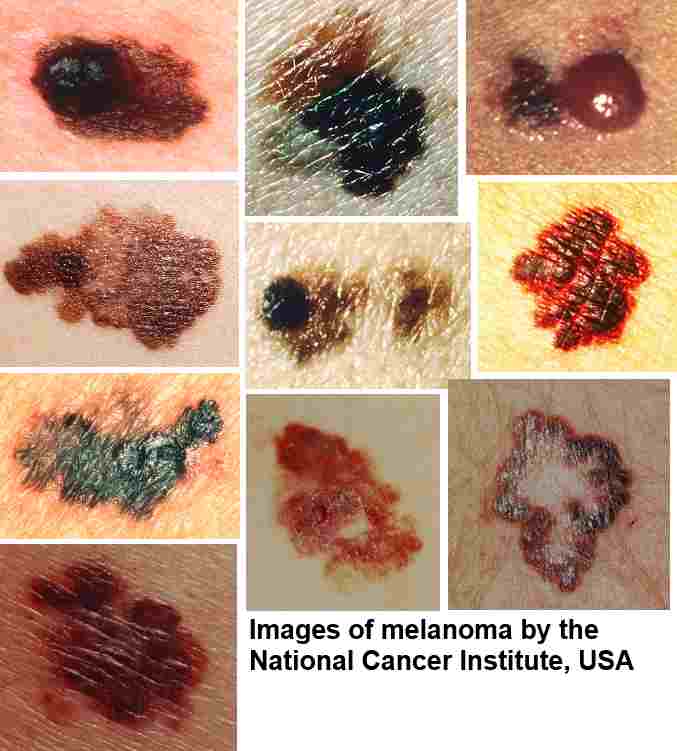 Is there a website with pictures that show the difference between melanomas and moles?