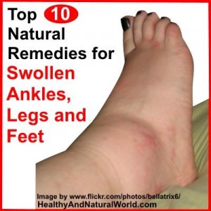 Top 10 Natural Remedies for Swollen Ankles, Legs and Feet