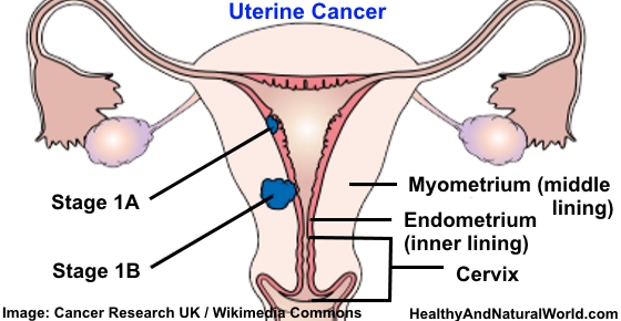 What are a few treatment options for uterine cancer?