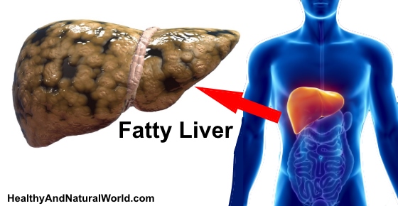 What lifestyle changes can help treat fatty liver disease?