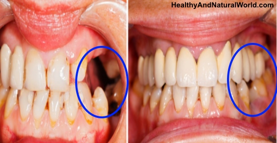 How to Regrow Teeth in Your Mouth in 9 Weeks