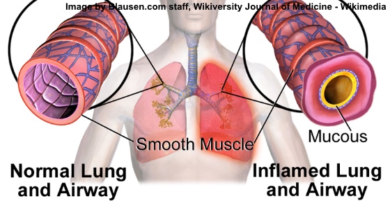 How To Get Rid Of Bronchitis Symptoms