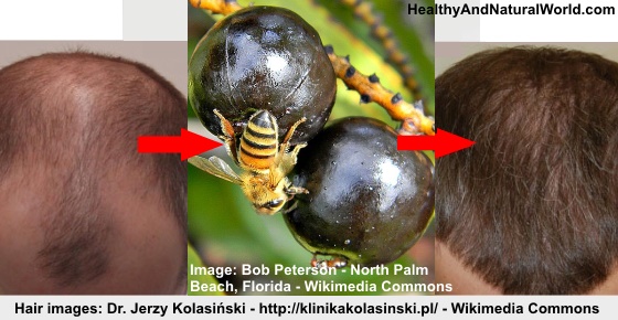 How to Use Saw Palmetto to Stop Hair Loss and Promote Hair Growth
