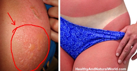 How can I quickly treat sunburn?