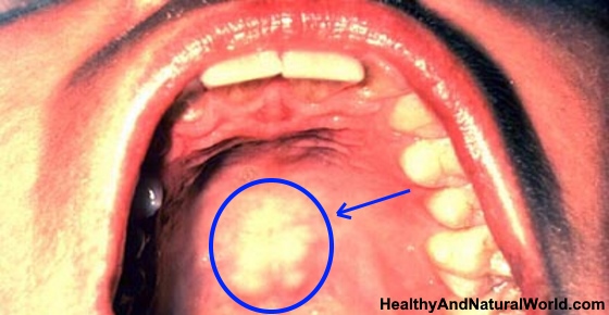 Roof Of Mouth Sore Possible Causes And Home Remedies
