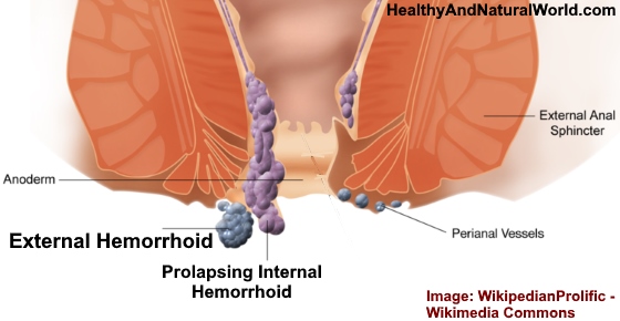 Do hemorrhoids go away?