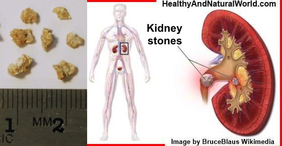 How to Treat Kidney Stones Naturally