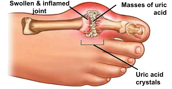 Discover The Best Natural Gout Treatments