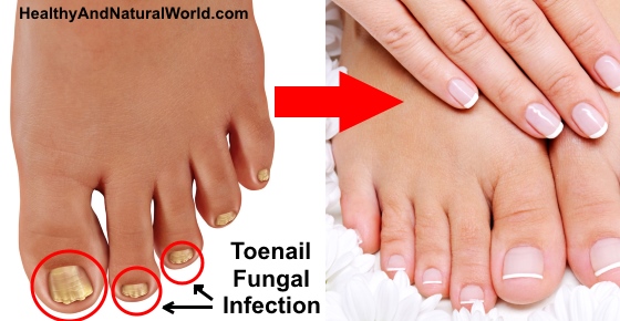 Toenail fungus treatment - Atlanta Podiatrists: Atlanta Foot and Ankle  Specialists