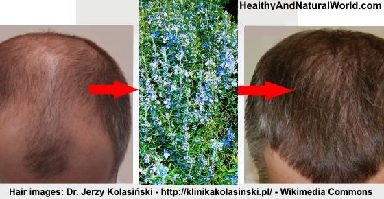 How to Use Rosemary for Treating Hair Loss