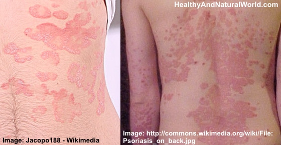 12 Natural Ways to Relieve Psoriasis