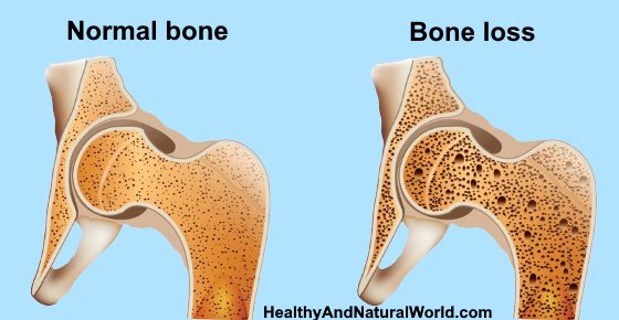 How to Increase Bone Density and Build Healthy Bones (Including Osteoporosis Diet)