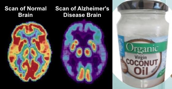 Top 5 Foods and Supplements to Delay Alzheimer's Disease and Dementia