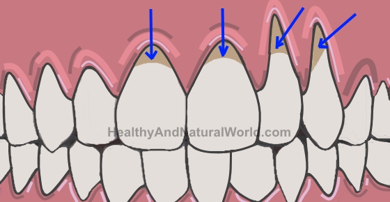 How to Get Rid of Gingivitis