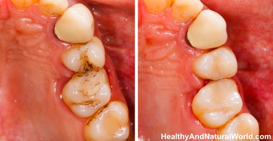 How to Fight Cavities and Tooth Decay Naturally