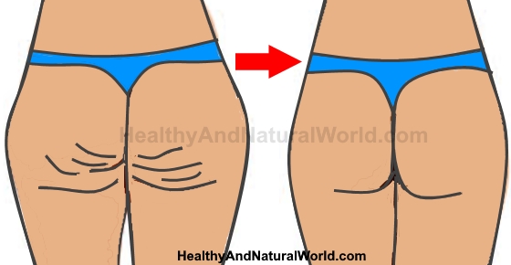 The Best Natural Ways to Get Rid Of Cellulite