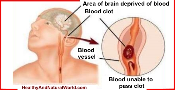 Early Signs of Stroke - Discover the Warning Signs that Can Save Life