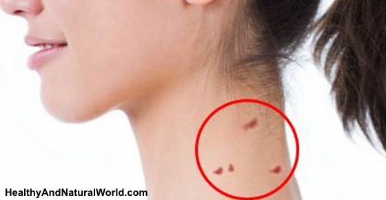 How to Remove Skin Tags and Warts Naturally and Cheaply at Home