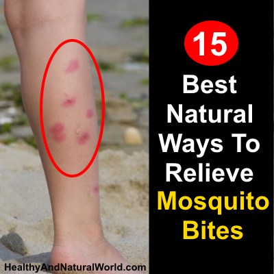 15 Best Natural Ways To Relieve Mosquito Bites