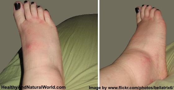 Top 10 Natural Remedies for Swollen Ankles, Legs and Feet