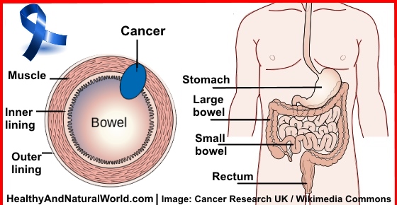 10 Warning Signs of Bowel (Colorectal) Cancer You Shouldn’t Ignore