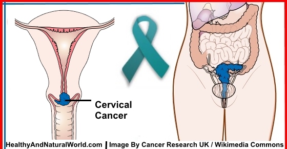 10 Warning Signs of Cervical Cancer You Shouldn't Ignore