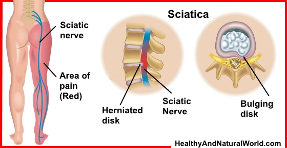 Top 8 Natural Treatments For Sciatic Pain