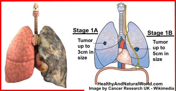 lung cancer signs symptoms smoking warning stages men ignore shouldn due types shouldnt advertisement healthyandnaturalworld amp