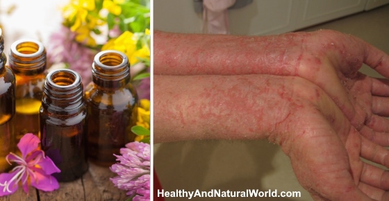 The Best Essential Oils For Eczema