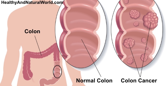 Colorectal Cancer: 11 Steps To Reduce Your Risk