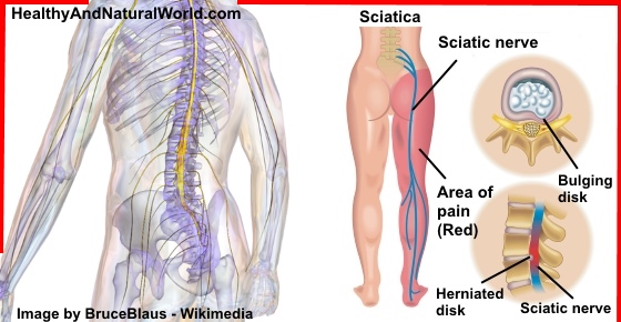 10 Tricks To Outsmart Sciatic Nerve Pain