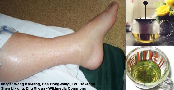 can amlodipine cause swollen legs