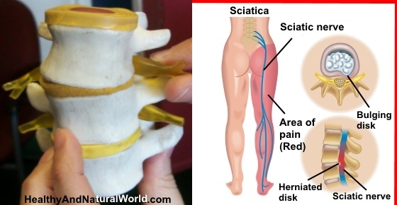The Best Yoga Poses to Soothe Sciatic Nerve Pain