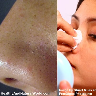 The Best Home Remedies to Get Rid of Whiteheads and Blackheads