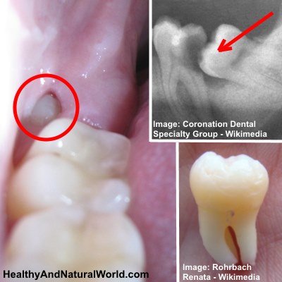 Home Remedies to Get Rid of Wisdom Tooth Pain