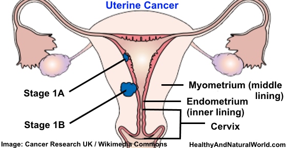 Uterine (Endometrial) Cancer – Facts, Prevention and Treatment