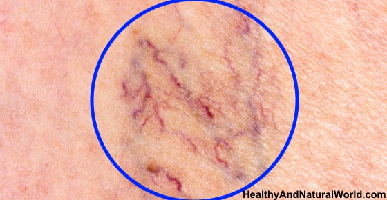 The Best Home Remedies to Get Rid of Spider Veins