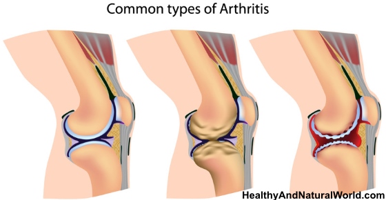 Arthritis - Foods to Eat and Foods to Avoid