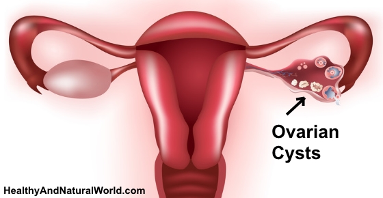 Ovarian Cysts - Warning Signs You Should Not Ignore