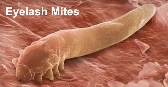 Demodex Folliculorum Nose