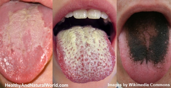 Warning Signs Your Tongue May Be Sending