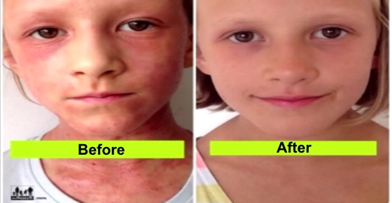 How to Use Raw Food Diet to Treat Eczema