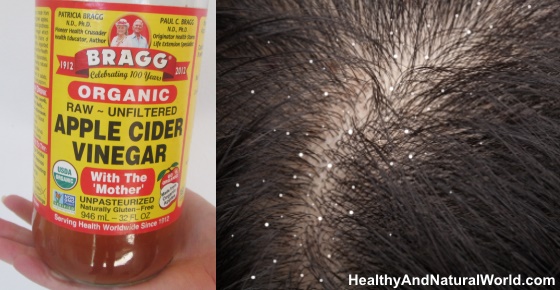 How to Use Apple Cider Vinegar to Get Rid of Dandruff