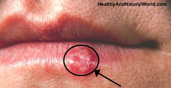 Best Home Remedies for Cold Sores