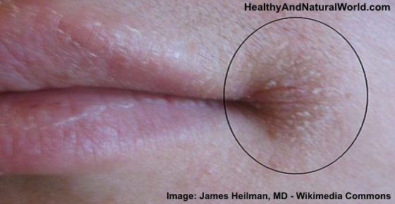 Natural Home Remedies for Angular Cheilitis (Cracked Corners of the Mouth)