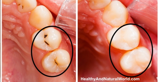 This Toothpaste Fills Cavities Without Drilling