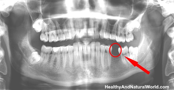 Medical Breakthrough: How You will be able to Regrow Your Teeth