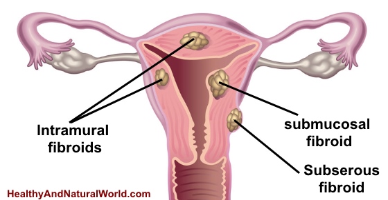 7 Warning Signs You May Have Uterine Fibroids